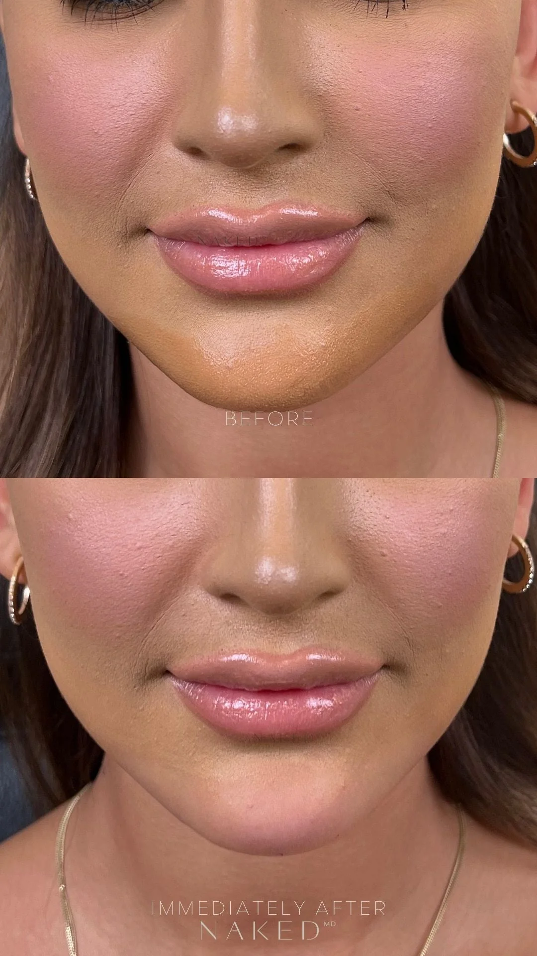 Chin Filler | New Client Offer - Image 7