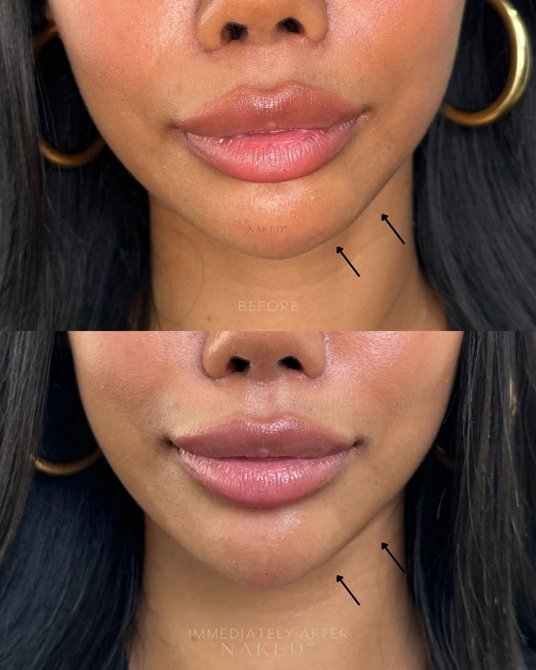 Chin Filler | New Client Offer - Image 9