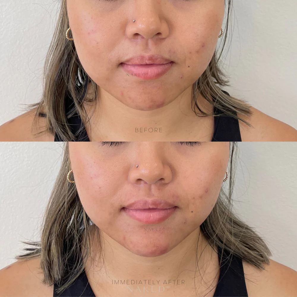 Chin Filler - Image 10
