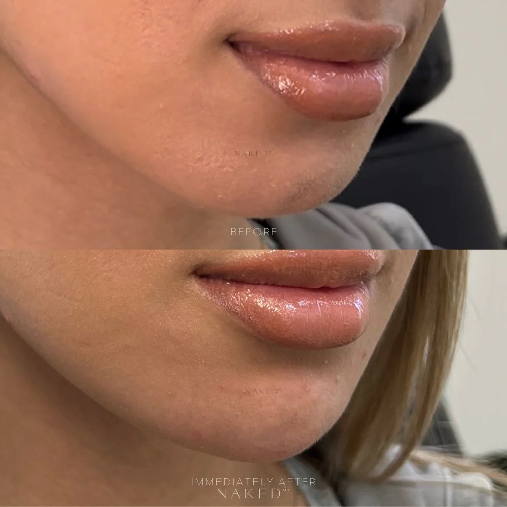 Chin Filler - Image 7