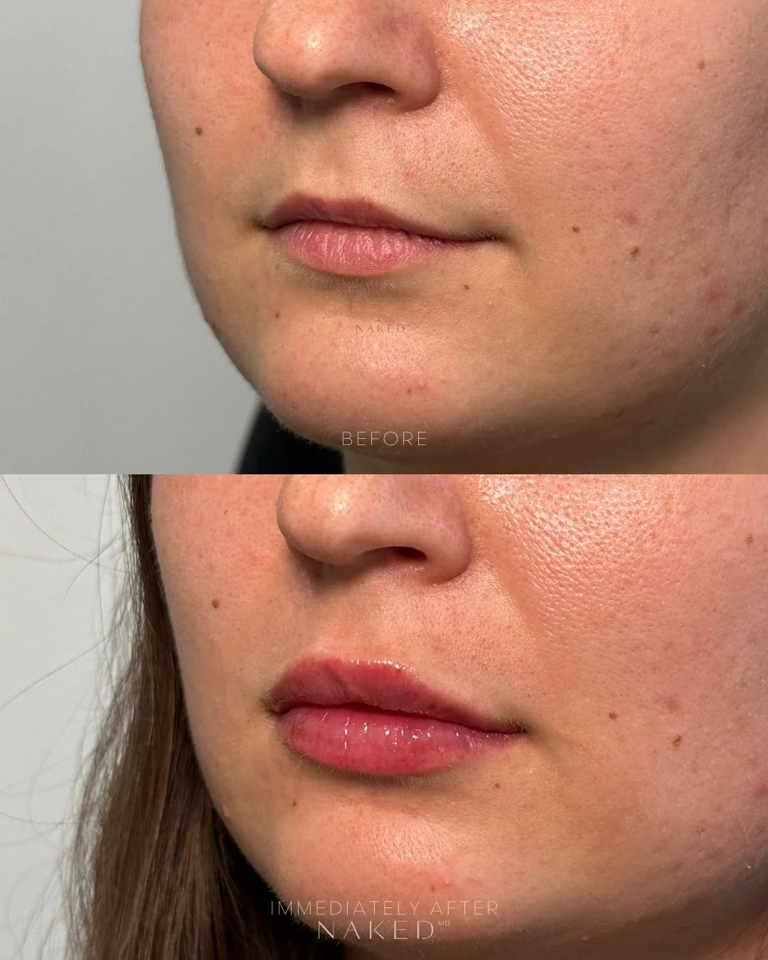 Naked Lips | Lip Filler - Image 22