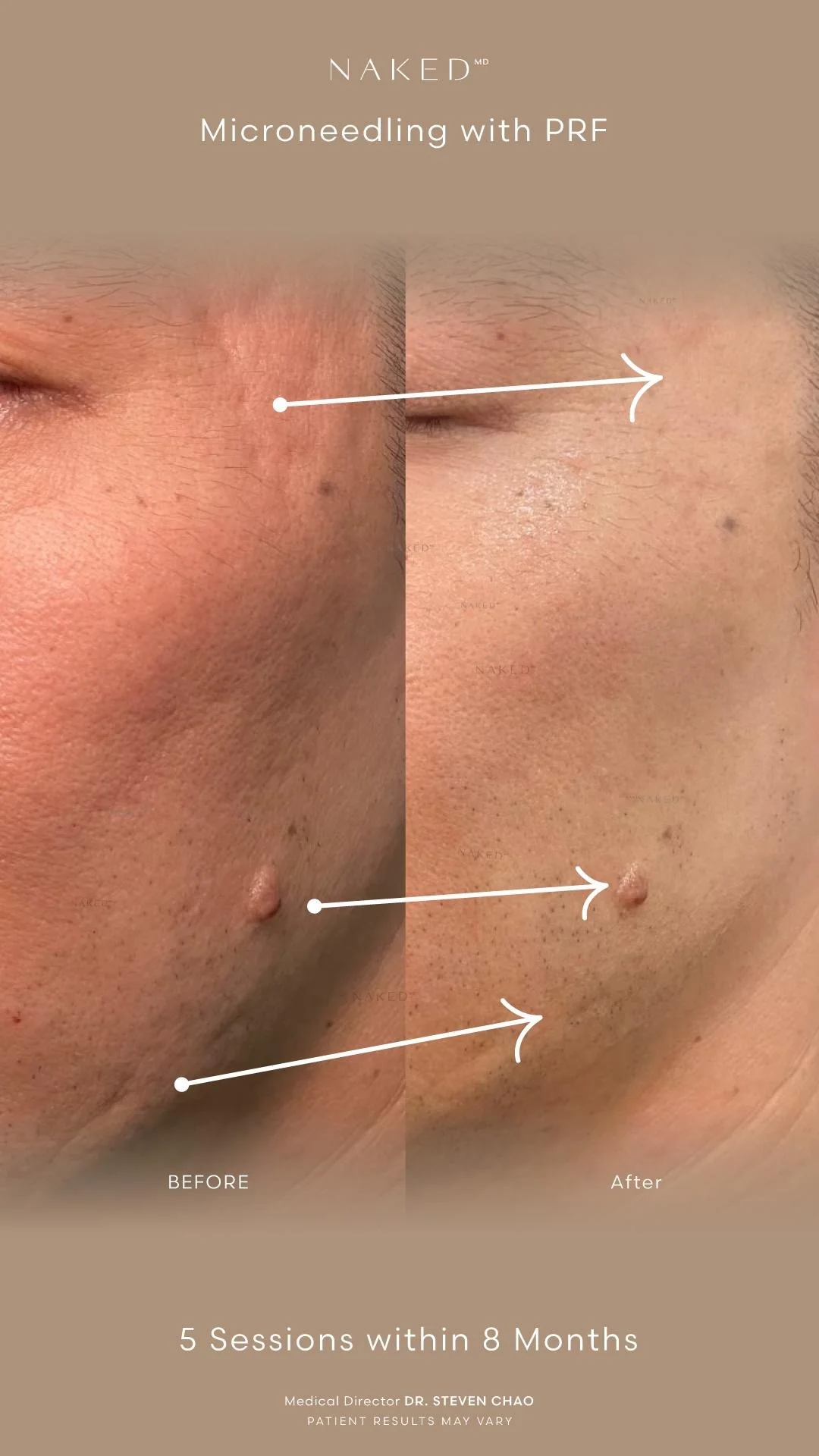 SkinPen® Microneedling - Image 3