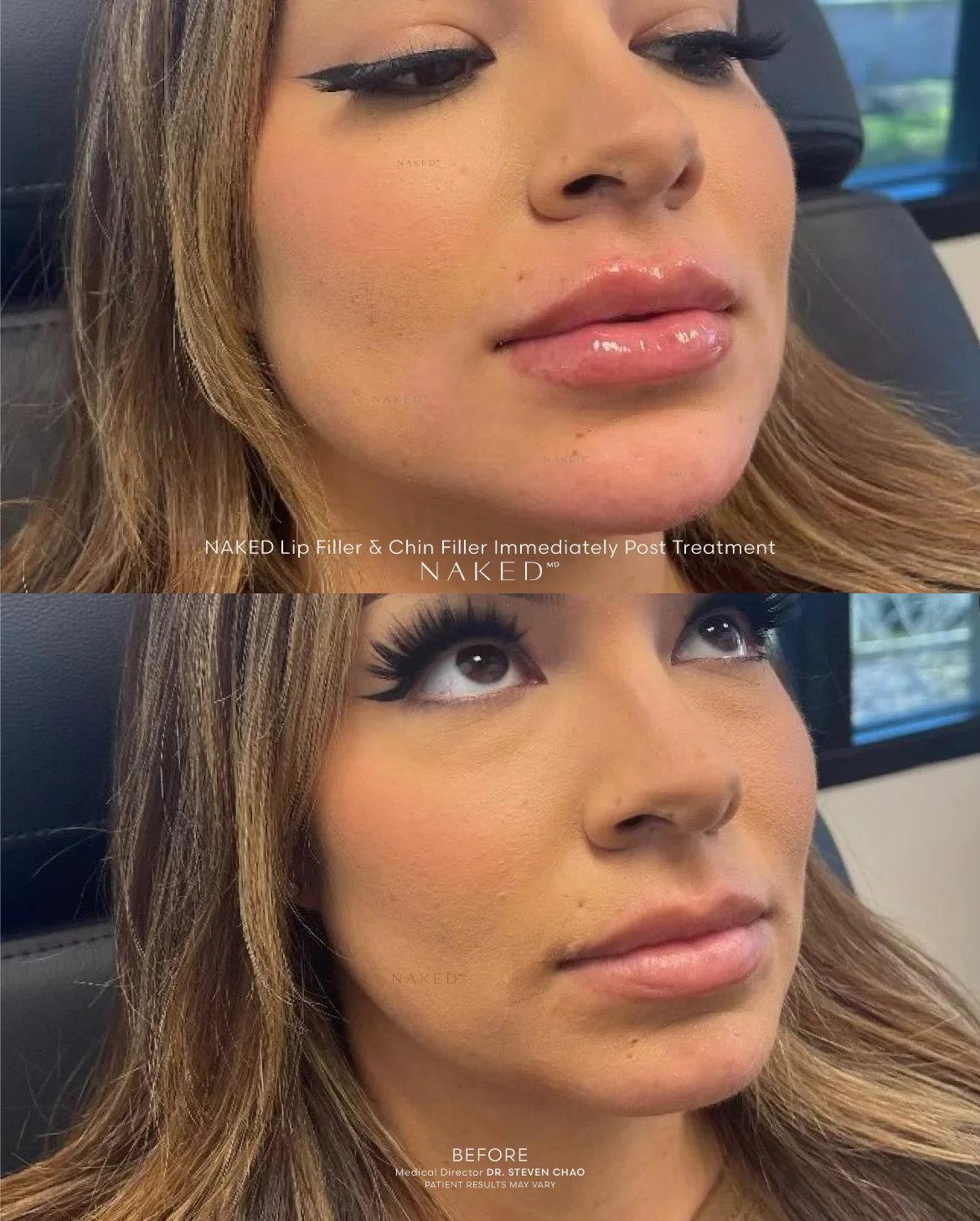 Naked Combo | Lips and Chin - Image 4
