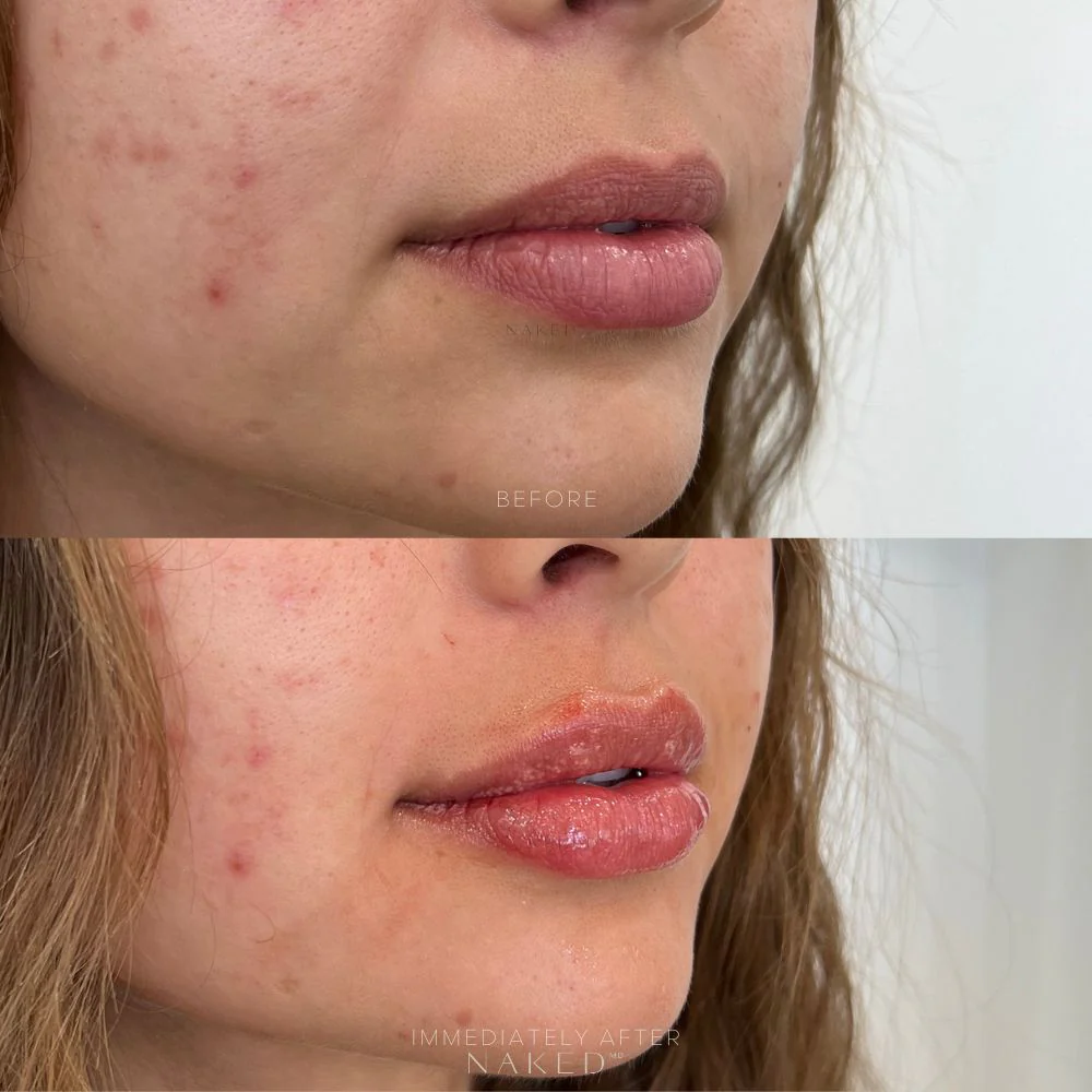 Lip Filler | New Client Offer - Image 14