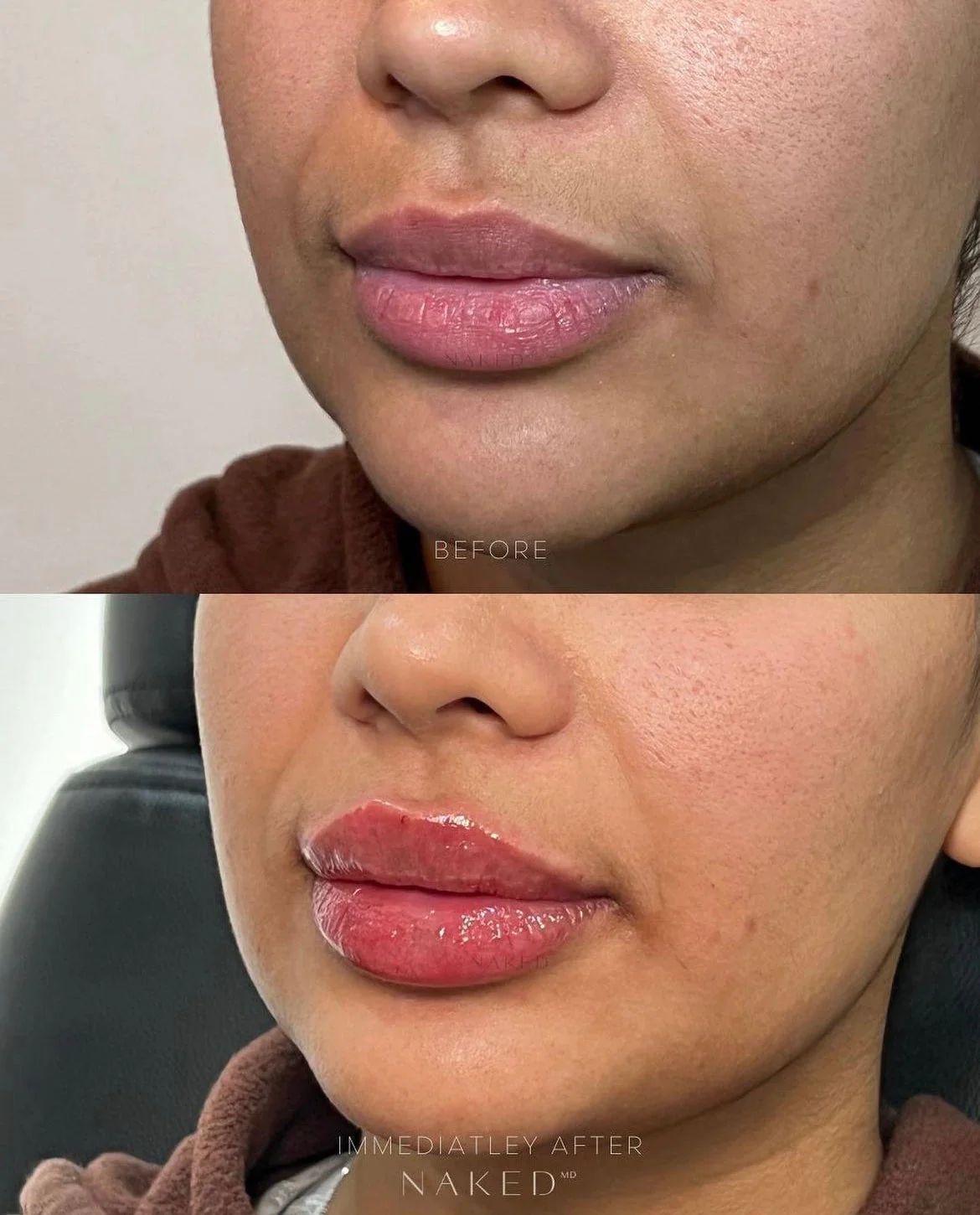 Lip Filler | New Client Offer - Image 20