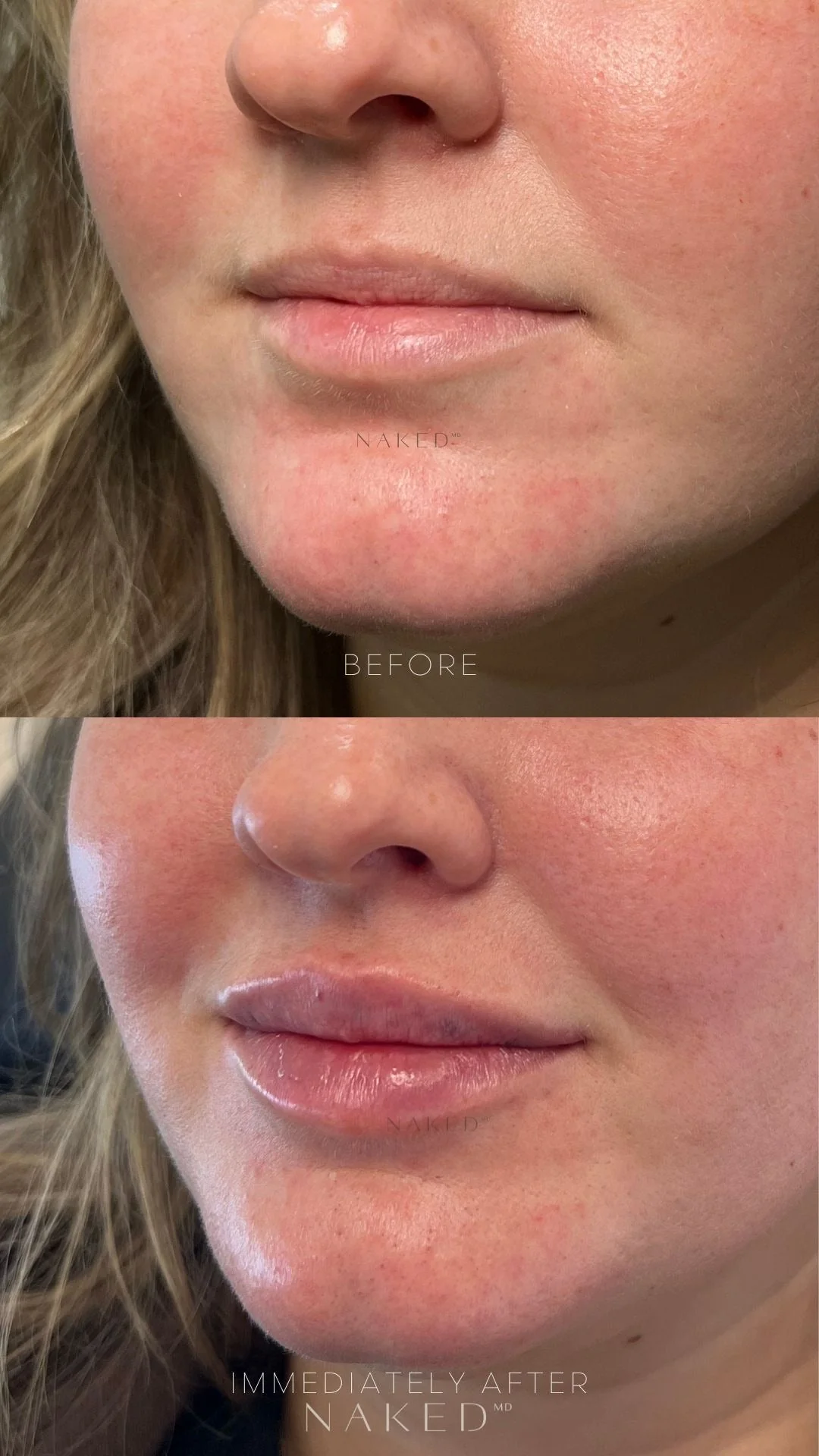Lip Filler | New Client Offer - Image 32