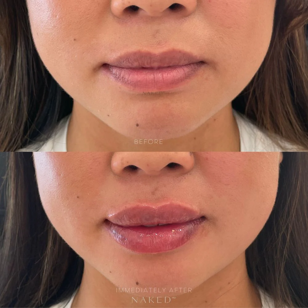 Lip Filler | New Client Offer - Image 34