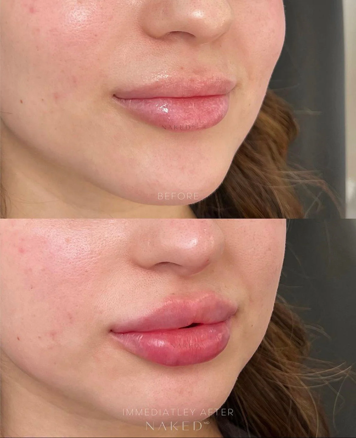 Lip Filler | New Client Offer - Image 42