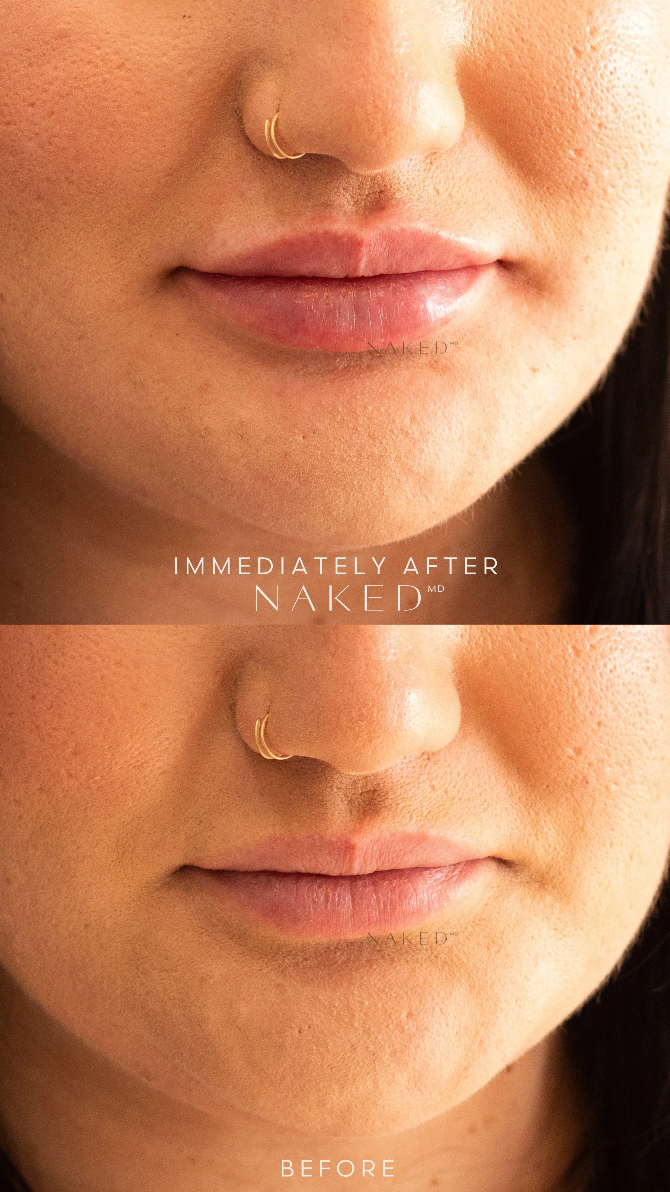 Lip Filler | New Client Offer - Image 52