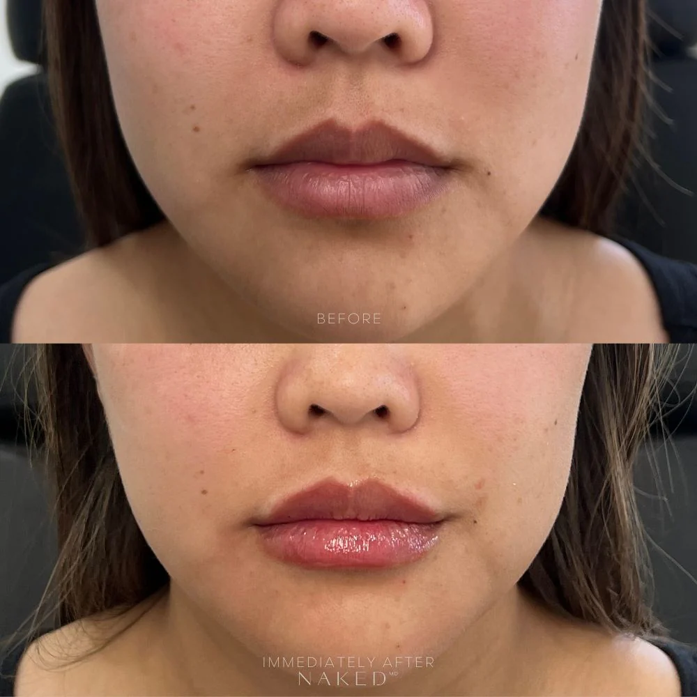 Lip Filler | New Client Offer - Image 67