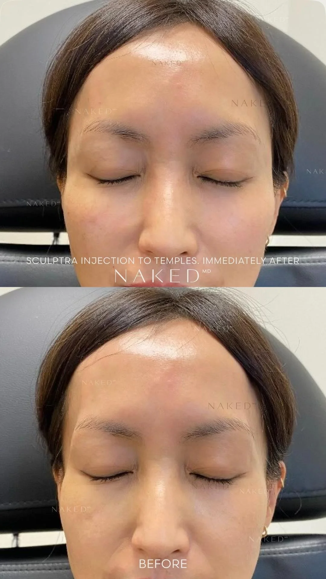 Sculptra® Filler - Image 5